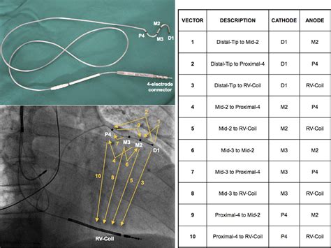 quadripolar pacing leads